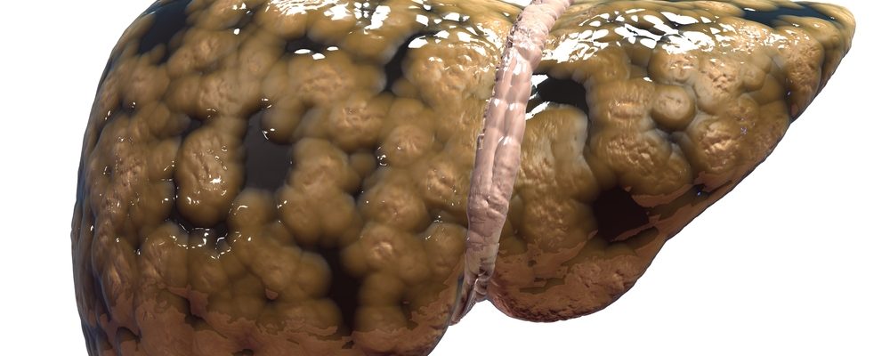 A Bigger Threat to Your Liver Than Alcohol